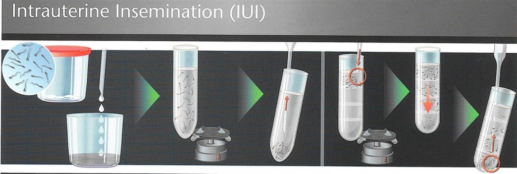 Intrauterine Insemination (IU)