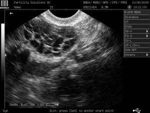 Ovarian hyperstimulation syndrome (OHSS) on ultrasound