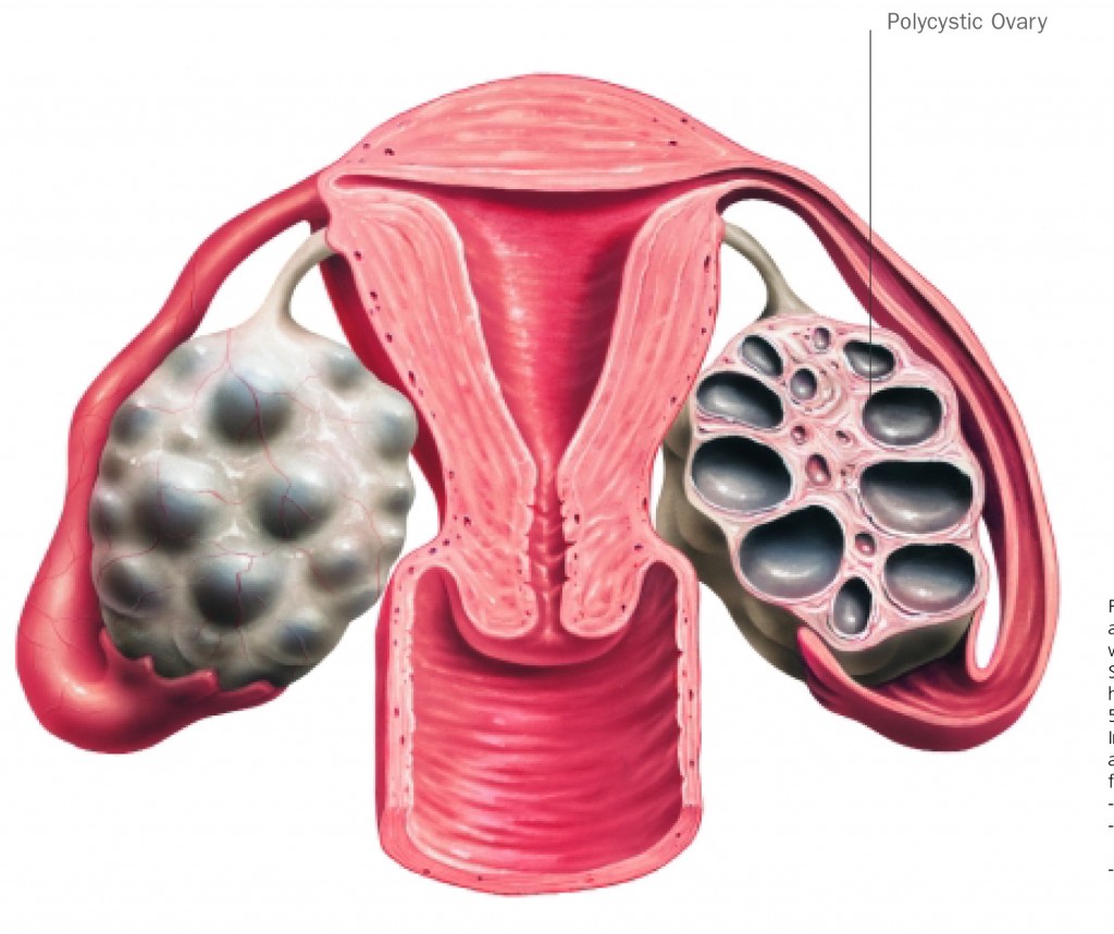 Pcos syndrome что это