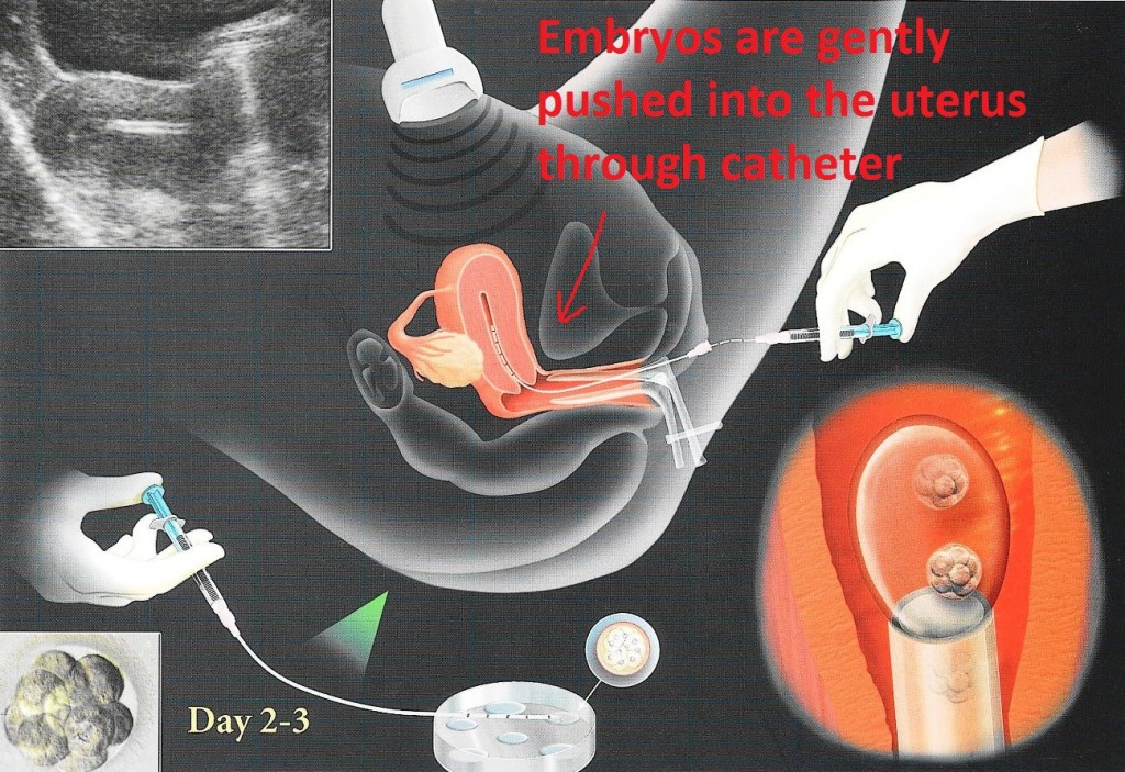 Embryo Transfer - step 4 of an ivf cycle