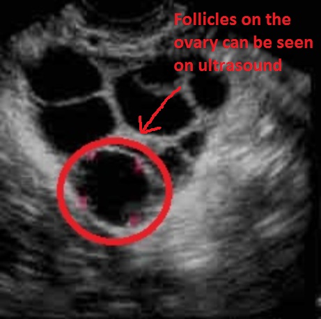 Follicle on ovary from ivf treatment shown in ultrasound scan