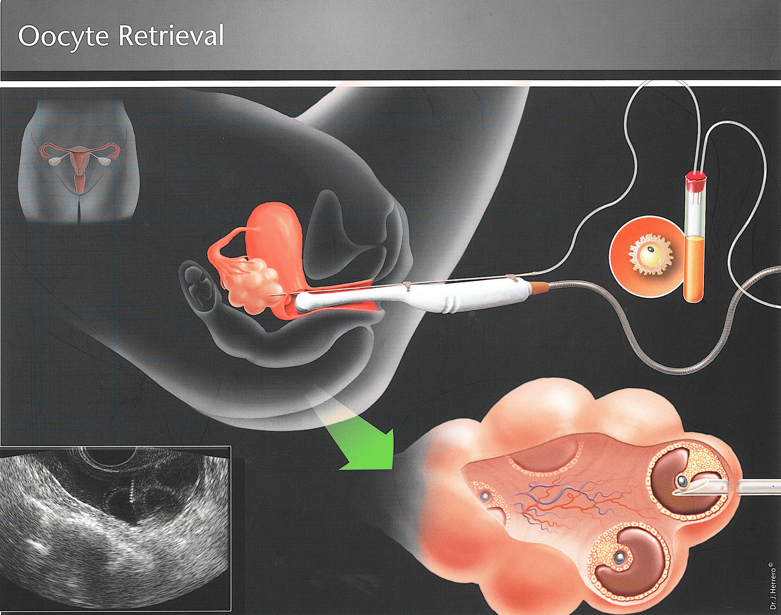 Oocyte Retrieval Fertility Solutions