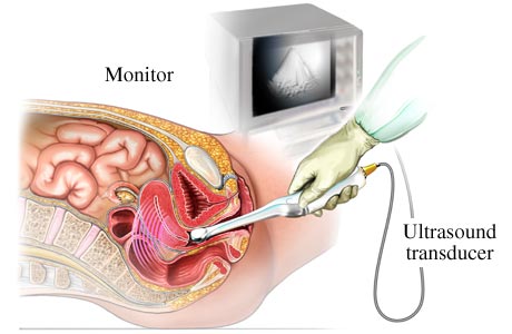 Transvaginal Ultrasound Scan