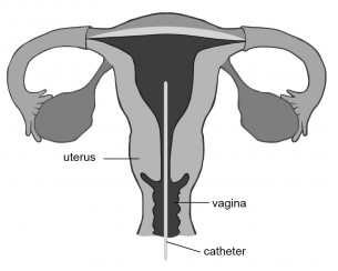catheter inserted into uterus