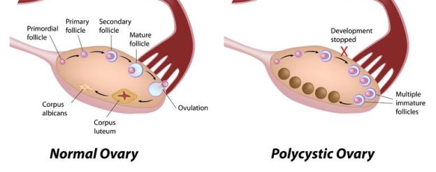 Image of a normal ovary and polycystic ovary syndrome; How your fertility is affected by PCOS and Type 2 diabetes.